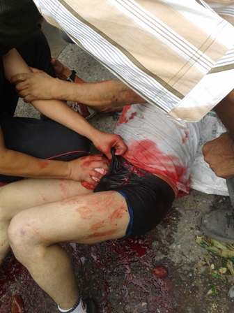 Image of one of those wounded by a bullet in Castilla, Coyaima, Tolima